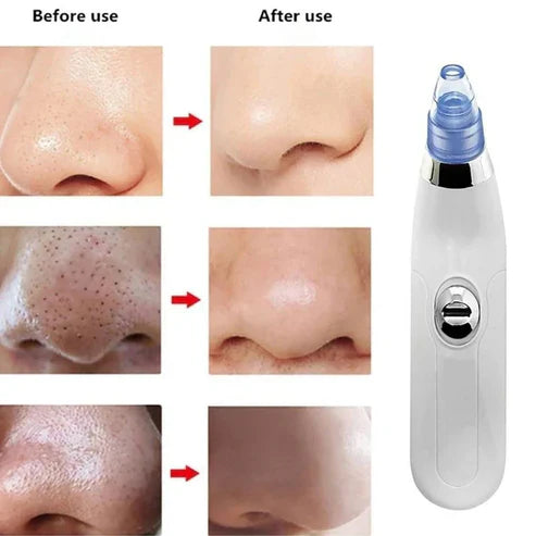 4in1 Suction Pore Cleaner, Health and Beauty
