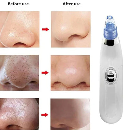 4in1 Suction Pore Cleaner, Health and Beauty 